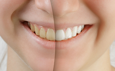 Up-close of a mouth that is half discolored teeth and half white teeth