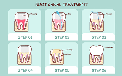 Cartoon tooth root canal treatment