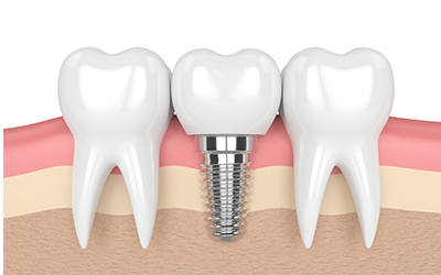 Dental implant