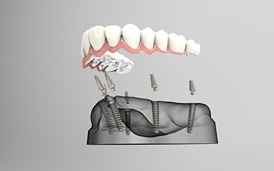 a model of teeth with implants