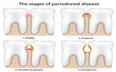 Stages of Perio
