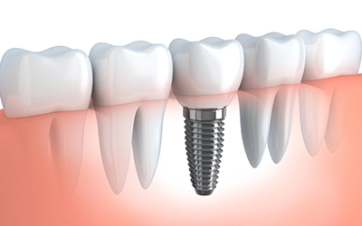 Dental Implant